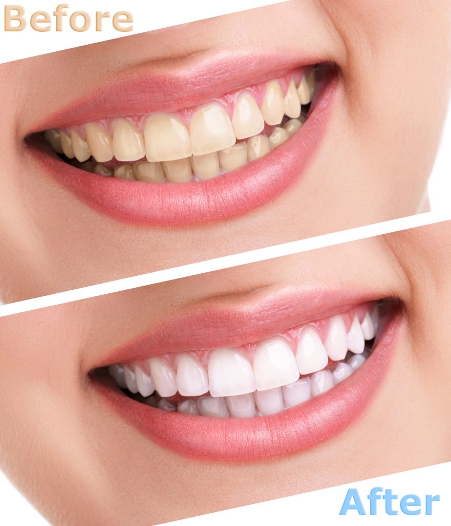 Teeth Whitening Medellin